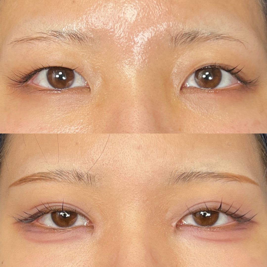 目元の症例写真（Before/After）