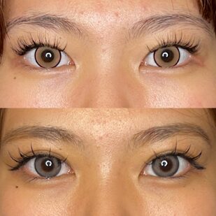 術前術後 比較画像