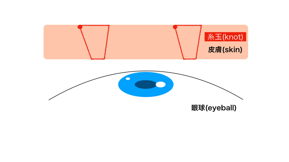 線状にかける2点留め図